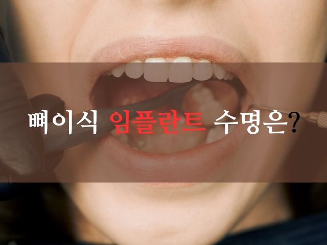 뼈이식 임플란트: 수명, 종류, 과정, 기간, 통증, 가격 정보!