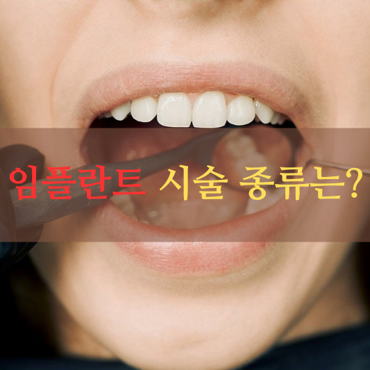 임플란트 시술종류: 다양한 선택과 그 특징들