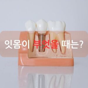 잇몸이 부엇을 때