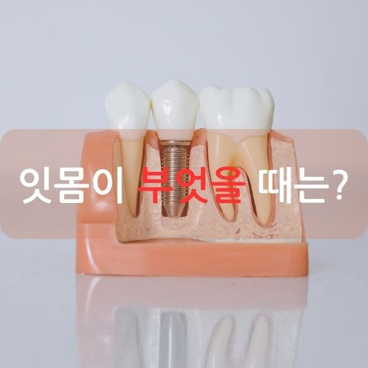 잇몸 부음, 어떻게 대처해야 할까요?