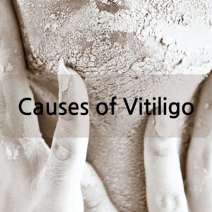 Causes of Vitiligo