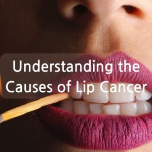 Understanding the Causes of Lip Cancer