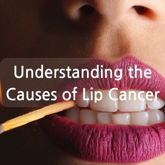 Understanding the Causes of Lip Cancer: A Comprehensive Guide