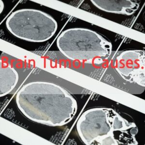 Brain Tumor Causes