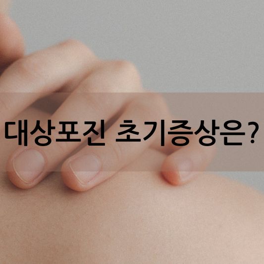 대상포진 초기증상 및 대상포진 정보 알아보기!