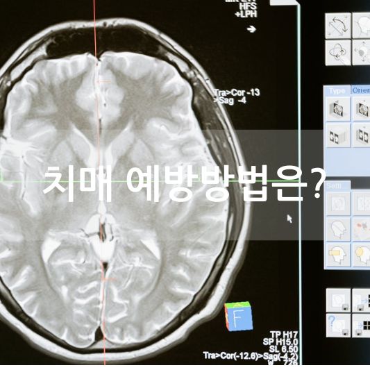 치매 예방 방법 : 관리방법,치매 예방운동 알아보기!