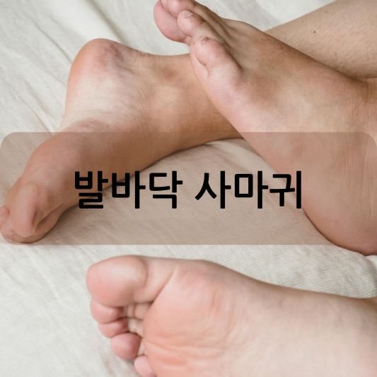 발바닥 사마귀 완벽 가이드: 원인부터 예방 방법 알아보기!