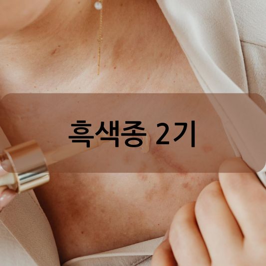 흑색종 2기 : 원인, 증상, 치료 방법 알아보기!