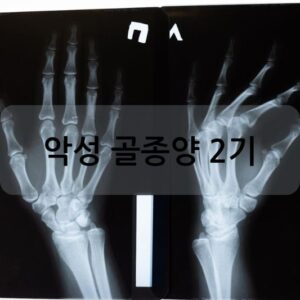 악성 골종양 2기