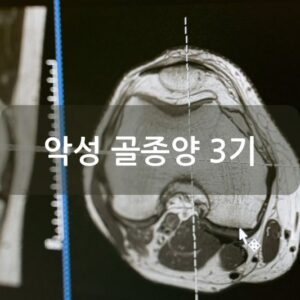 악성 골종양 3기