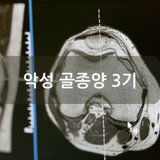 악성 골종양 3기 : 원인, 증상, 치료 방법 알아보기!