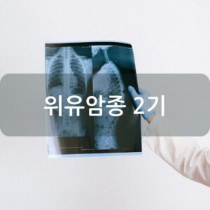 위유암종 2기