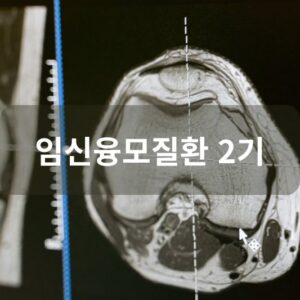 임신융모질환 2기