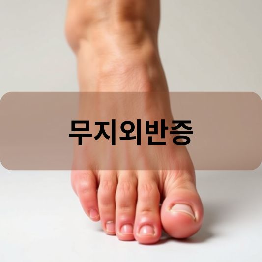 무지외반증 교정기 효과 2배 올리는 방법 알아보기!
