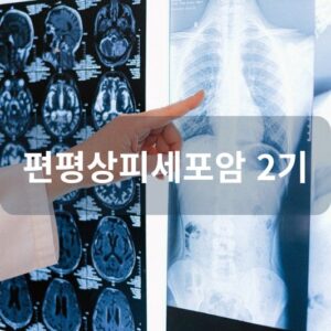편평상피세포암 2기