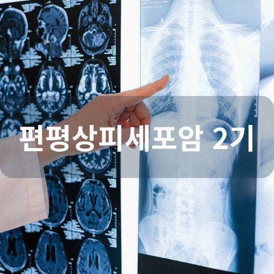 편평상피세포암 2기: 원인, 증상, 치료 방법 알아보기!