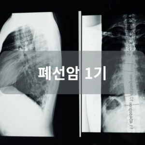 폐선암 1기
