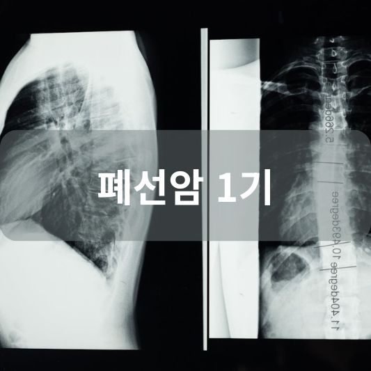 폐선암 1기: 원인, 증상, 치료 방법 알아보기!