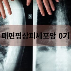 폐편평상피세포암 0기