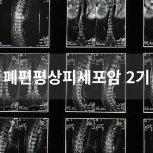 폐편평상피세포암 2기