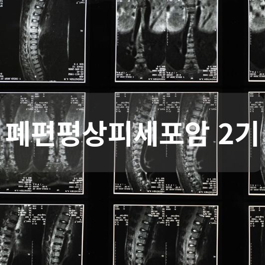 폐편평상피세포암 2기: 원인, 증상, 치료 방법 알아보기!