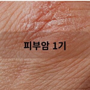 피부암 1기