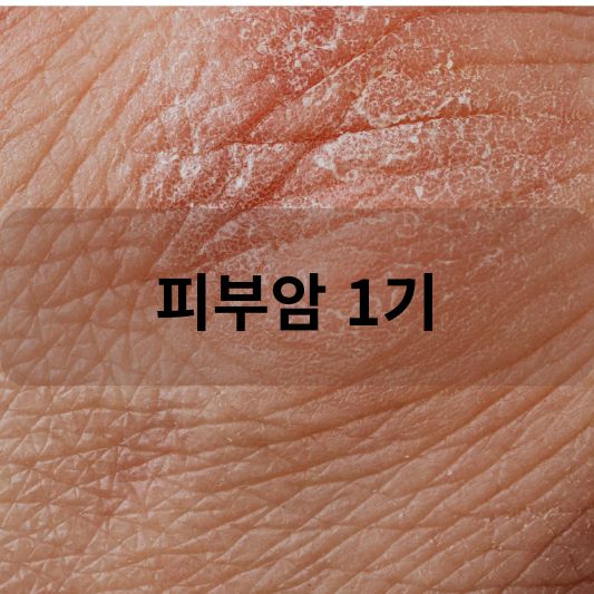 피부암 1기: 원인, 증상, 치료 방법 알아보기!