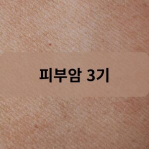 피부암 3기