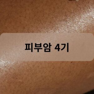피부암 4기