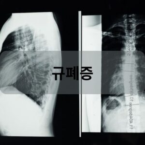 규폐증