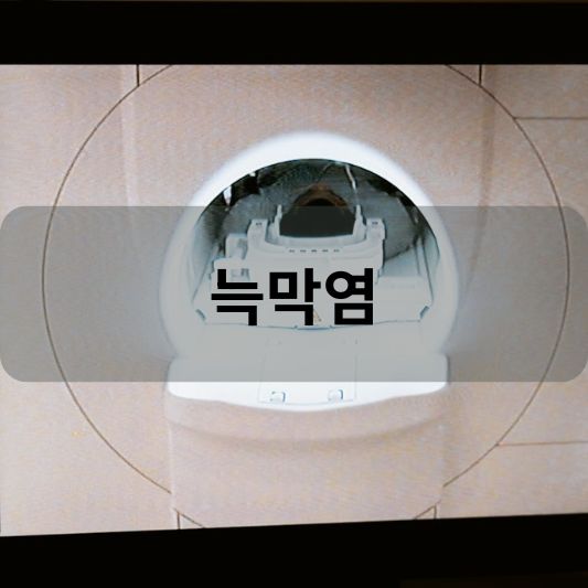 늑막염: 원인, 증상, 치료 방법 알아보기!