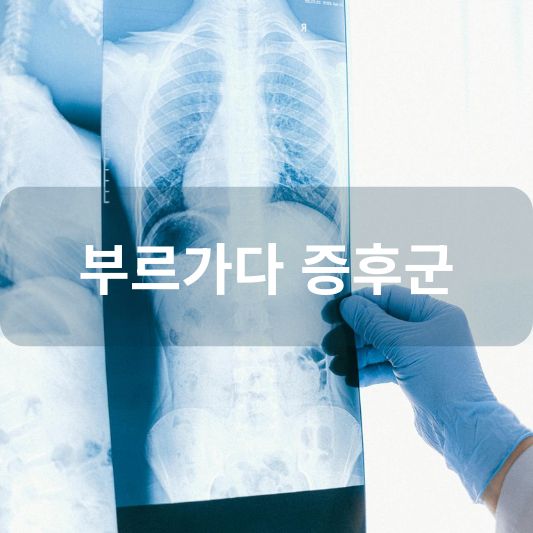 부르가다 증후군: 원인, 증상, 치료 방법 알아보기!