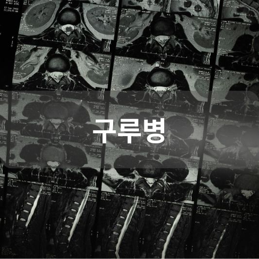 구루병: 원인, 증상, 치료 방법 알아보기!