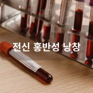 전신 홍반성 낭창