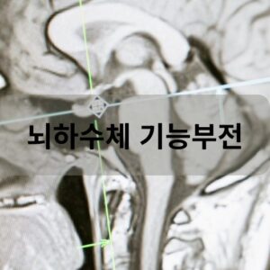 뇌하수체 기능부전