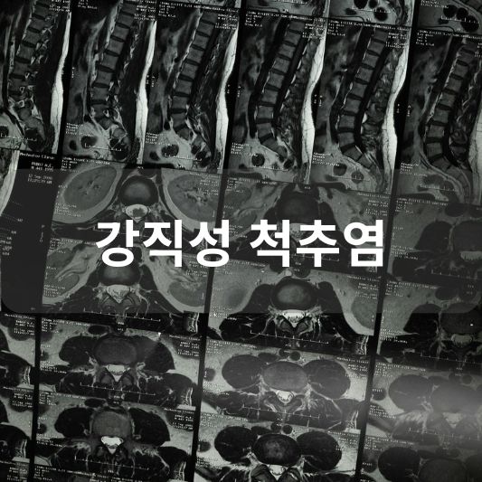 강직성 척추염: 원인, 증상, 치료 방법 알아보기!