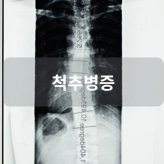 척추병증: 원인, 증상, 치료 방법 알아보기!