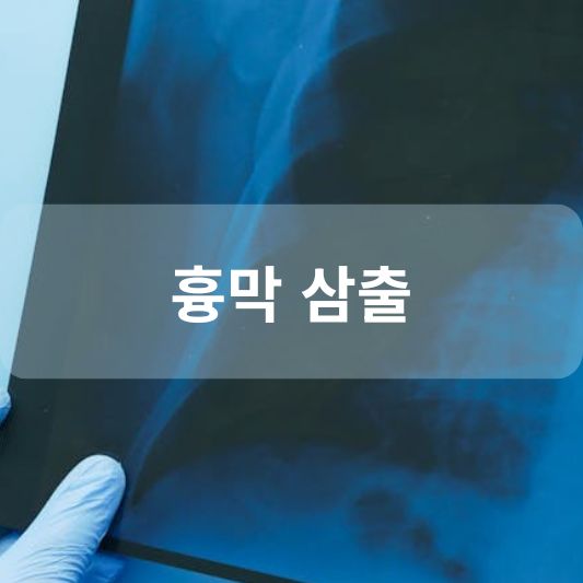흉막 삼출: 원인, 증상, 치료 방법 알아보기!