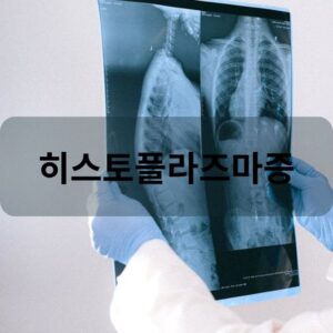 히스토플라즈마증