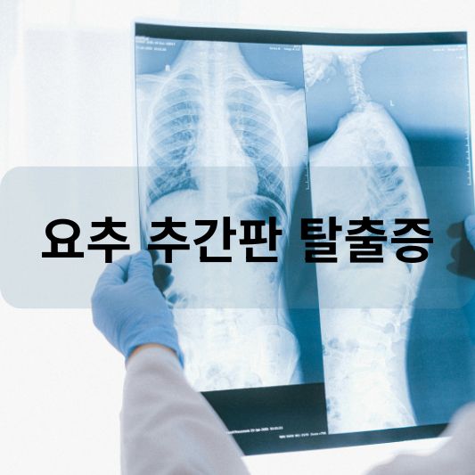 요추 추간판 탈출증: 원인, 증상, 치료 방법 알아보기!