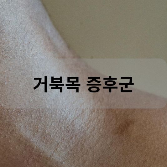 거북목 증후군: 원인, 증상, 치료 방법 알아보기!