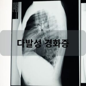 다발성 경화증