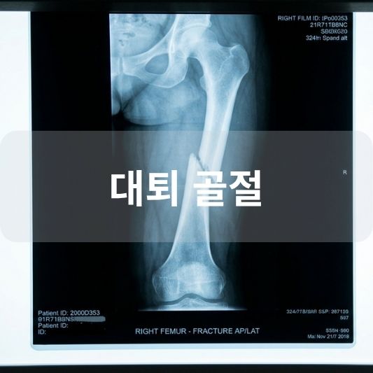 대퇴 골절: 원인, 증상, 치료 방법 알아보기!
