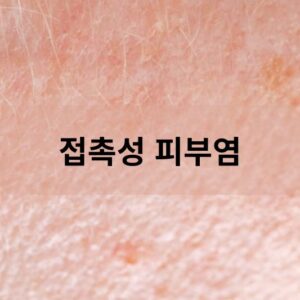 접촉성 피부염