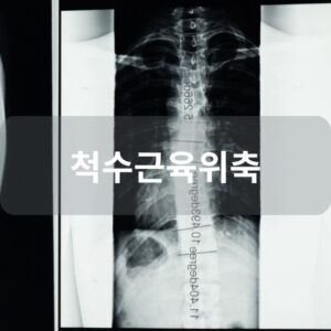 척수근육위축