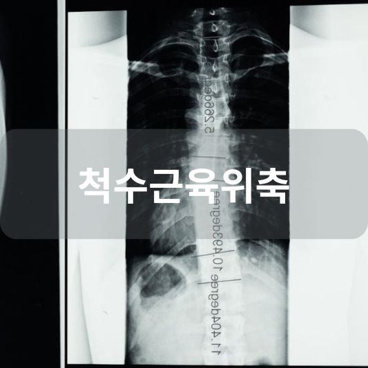척수근육위축: 원인, 증상, 치료 방법 알아보기!