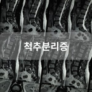 척추분리증