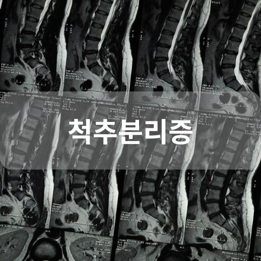 척추분리증: 원인, 증상, 치료 방법 알아보기!