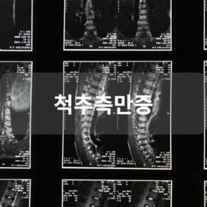 척추측만증