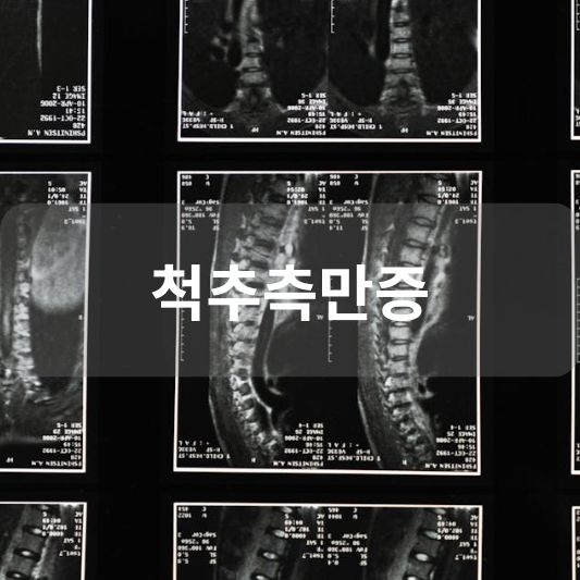척추측만증: 원인, 증상, 치료 방법 알아보기!